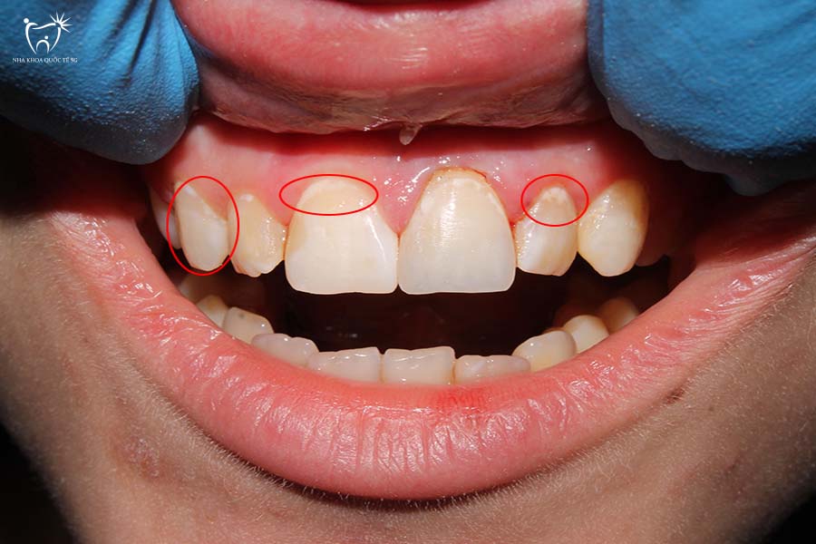 Những rủi ro cần lưu ý trước khi gắn sứ