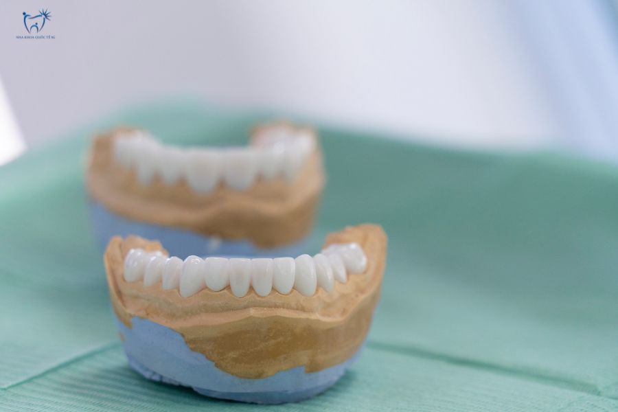 Nha Khoa Quốc Tế Sài Gòn Mô hình mô phỏng dán sứ trên hàm giả