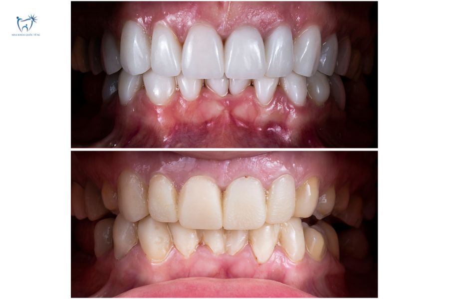 Nha Khoa Quốc Tế Sài Gòn Có nhiều loại vật liệu dán Laminate tự nhiên như răng thật