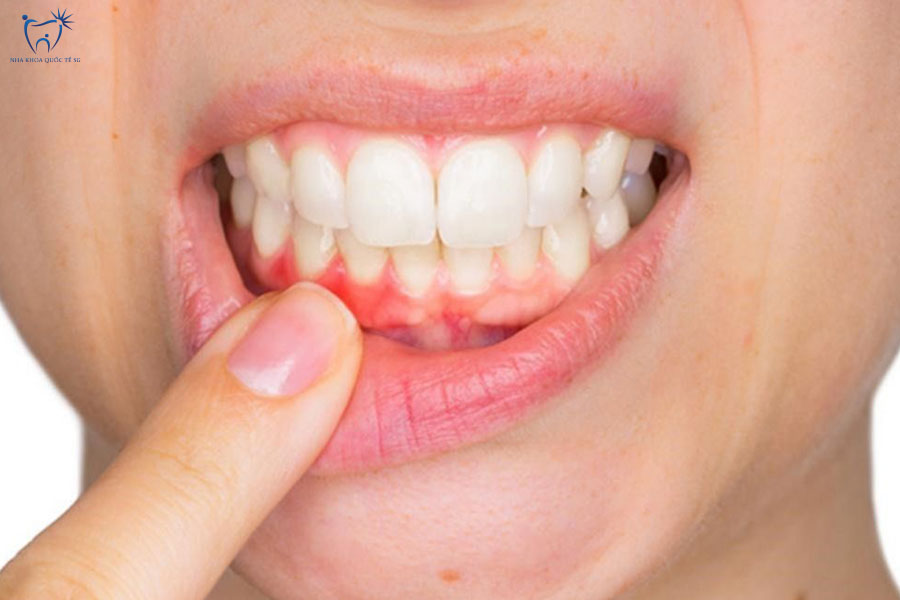 Cận cảnh tình trạng viền nướu bị sưng đỏ và tụt lợi