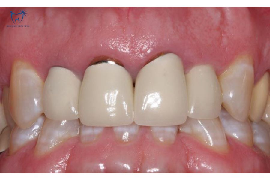 Cầu răng sứ bị đen viền nướu