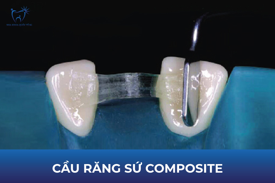 Cầu răng composite là loại cầu răng tạm thời