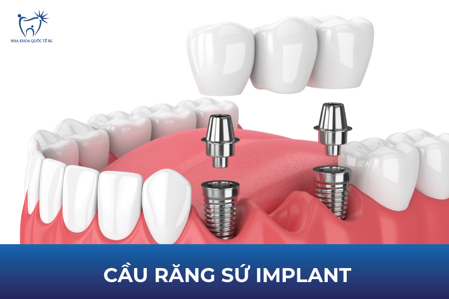 Cầu răng sứ trên Implant là phương pháp phục hồi răng hiện đại