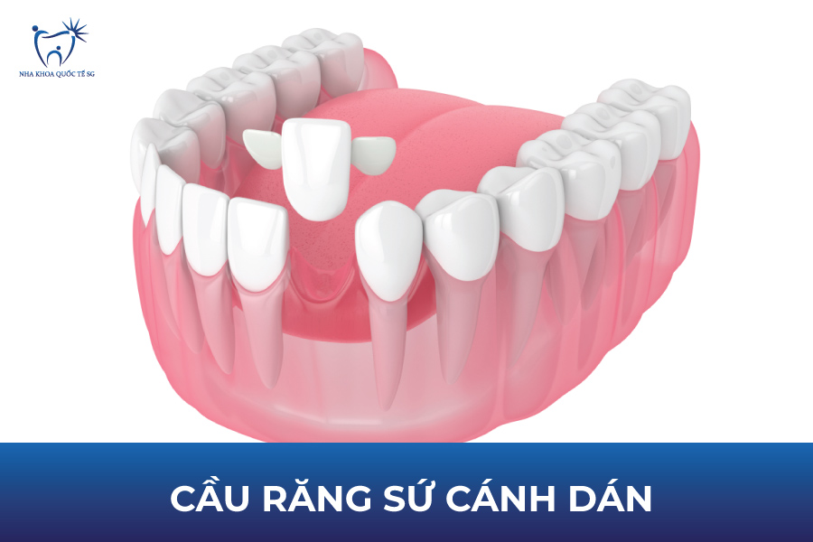 Cầu răng sứ cánh dán giúp bảo tồn răng thật