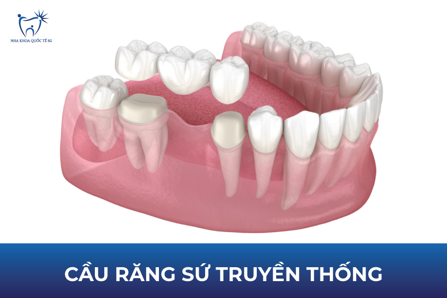Cầu răng sứ truyền thống với 2 răng trụ