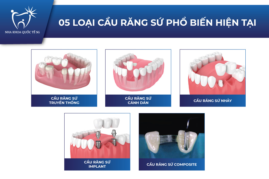 Các loại cầu răng sứ phổ biến hiện nay