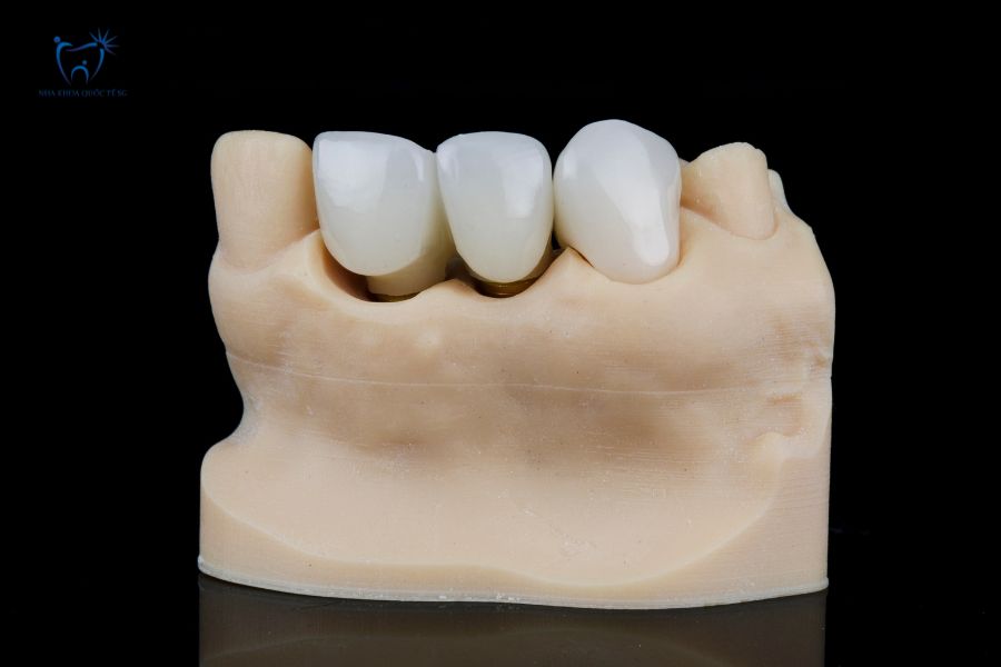 Mô hình cầu răng sứ trên hàm giả