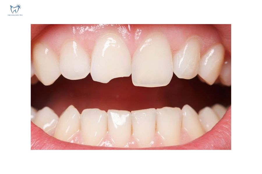 Cầu răng sứ bị mẻ ở răng cửa