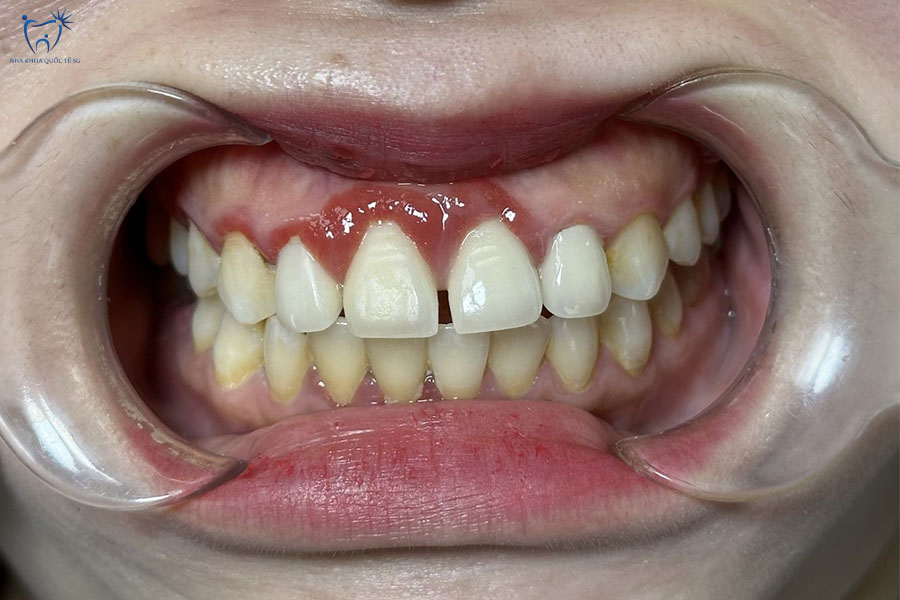 Bệnh nhân bị viêm lợi điều trị tại Nha Khoa Quốc Tế SG