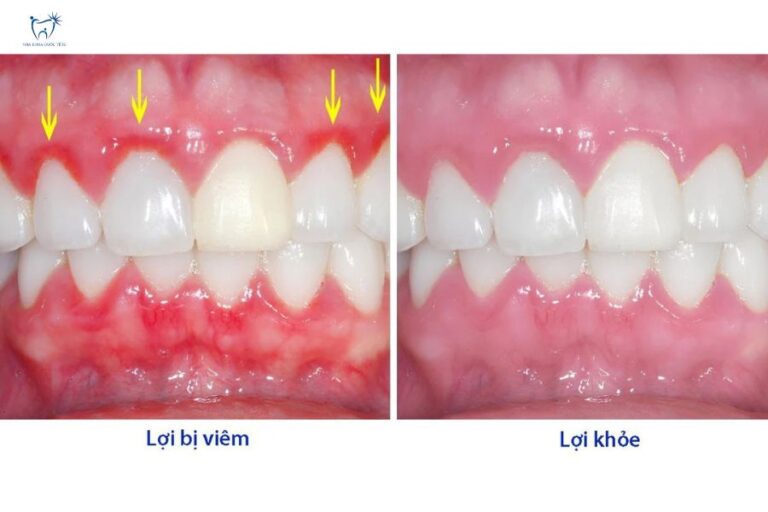 Tình trạng lợi bị viêm nhiễm và lợi khỏe mạnh