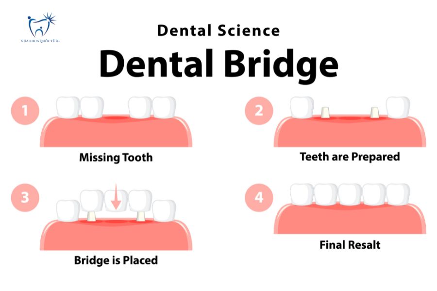 Mô phỏng chi tiết quy trình làm cầu răng sứ