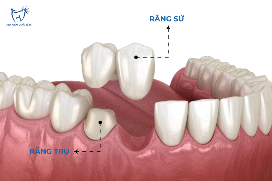 Quy trình làm cầu răng sứ nhảy giống như cầu răng sứ truyền thống