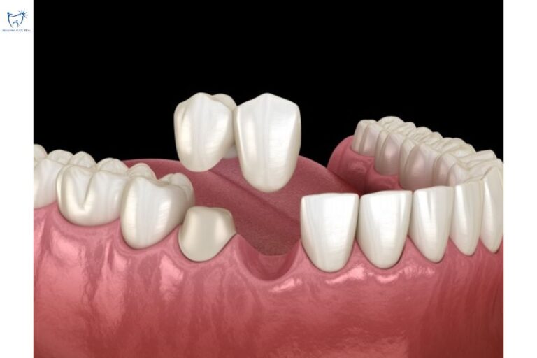 Mô hình cầu răng sứ nhảy với 1 răng trụ