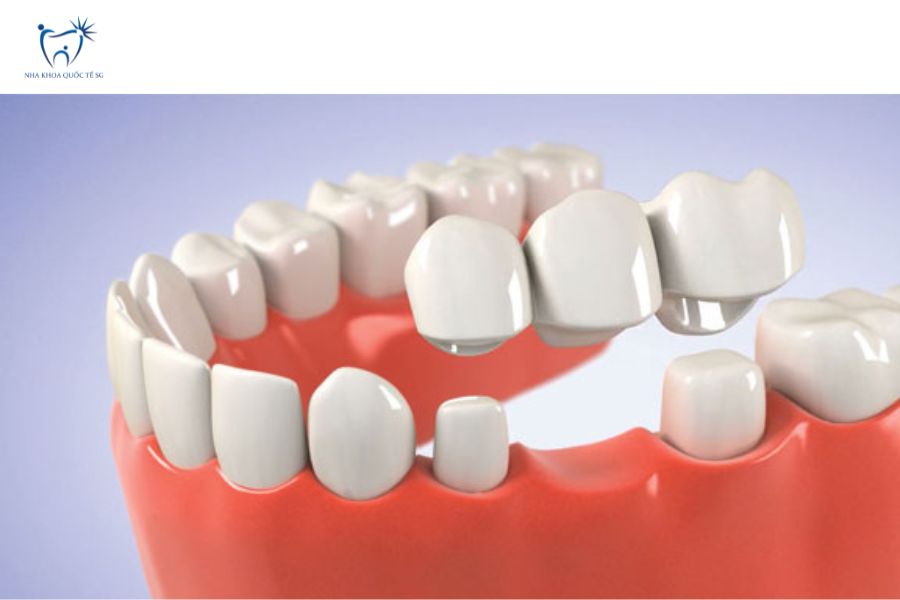 Mô hình cầu răng sứ truyền thống với 2 răng trụ