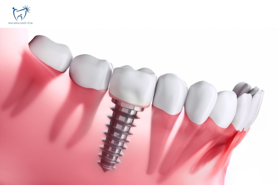 Mô hình cấy ghép implant vào xương hàm