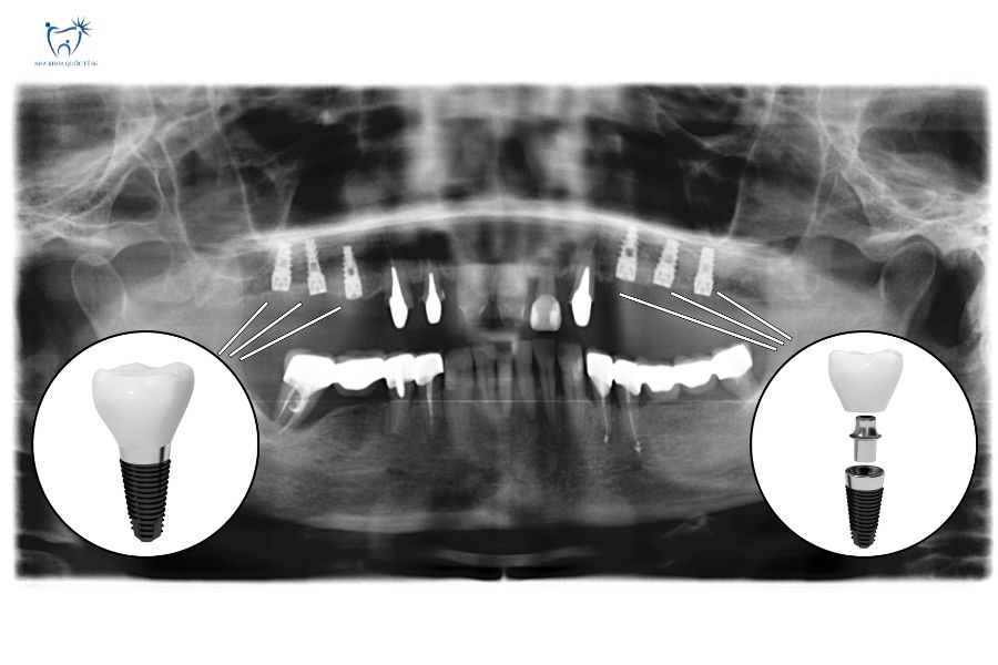 Hình X-Quang chụp CT-Conebeam sau khi cấy ghép implant