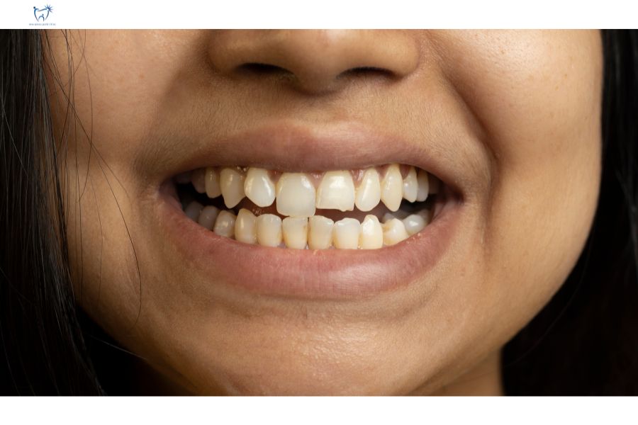 Lưu ý dấu hiệu khi bị mẻ cầu răng sứ cần đi tái khám