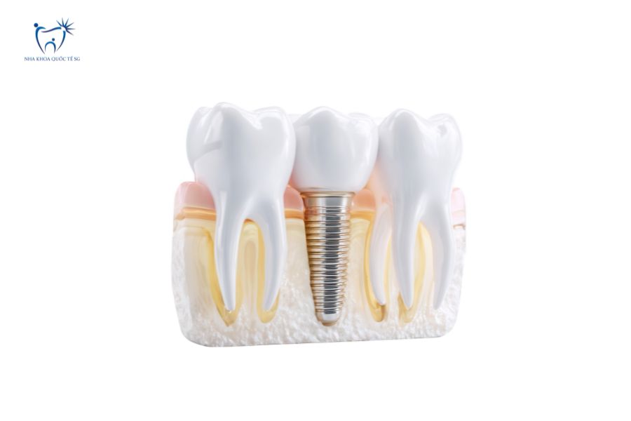 Cấy ghép trụ Implant