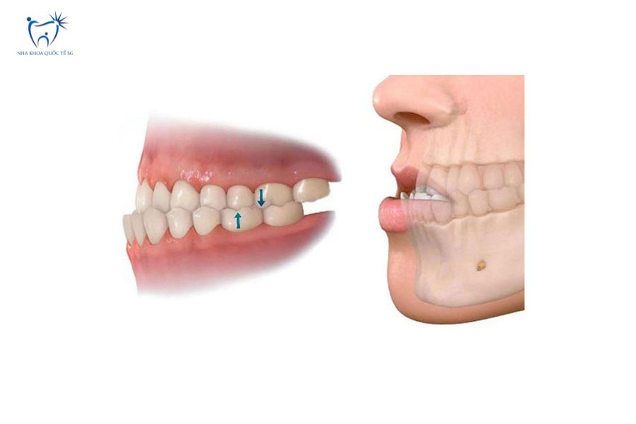 Trường hợp khớp cắn ngược không nên làm cầu răng sứ nhảy