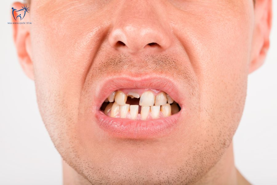 Trường hợp mất 1 răng cửa nên làm cầu răng sứ nhảy