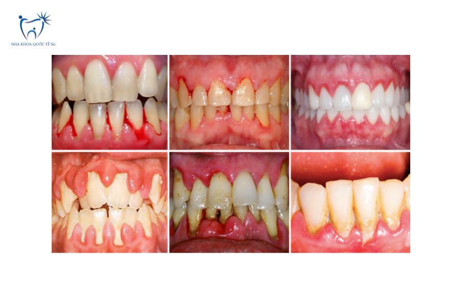 Bệnh lý răng miệng cần điều trị trước khi gắn cầu răng sứ