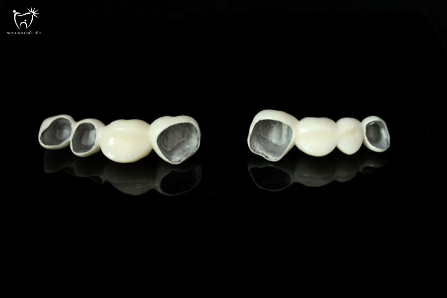 Răng sứ kim loại đen viền nướu mất thẩm mỹ