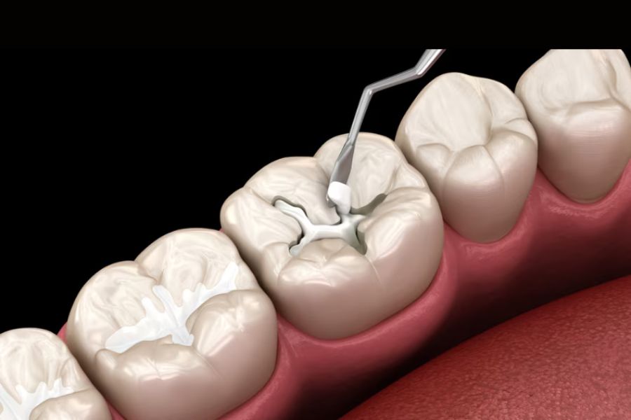 Trám răng composite răng bị sâu nhẹ
