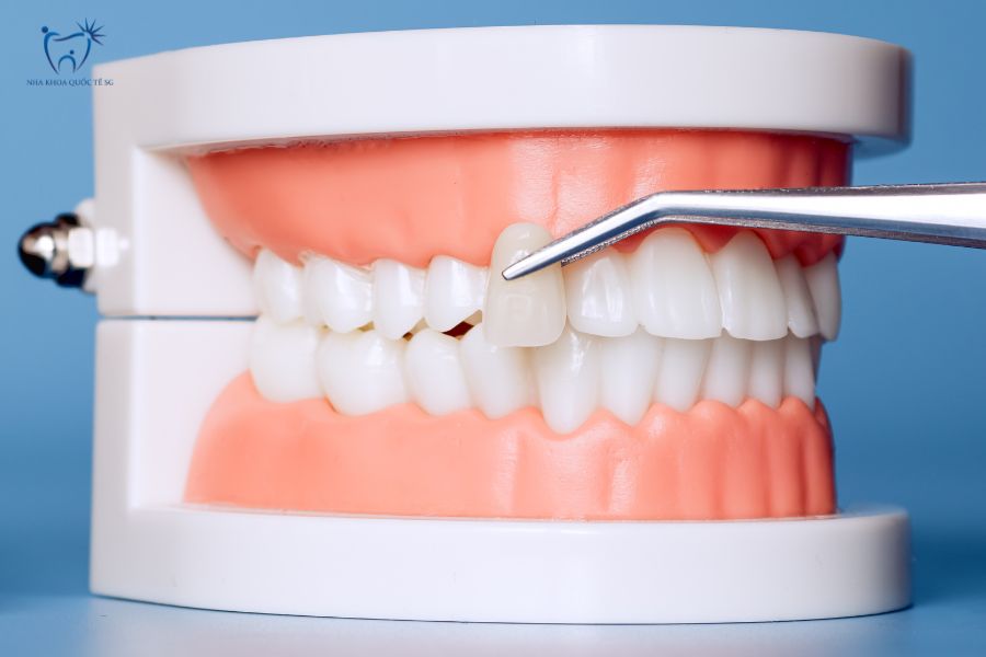 Cần chọn loại vật liệu phù hợp với răng