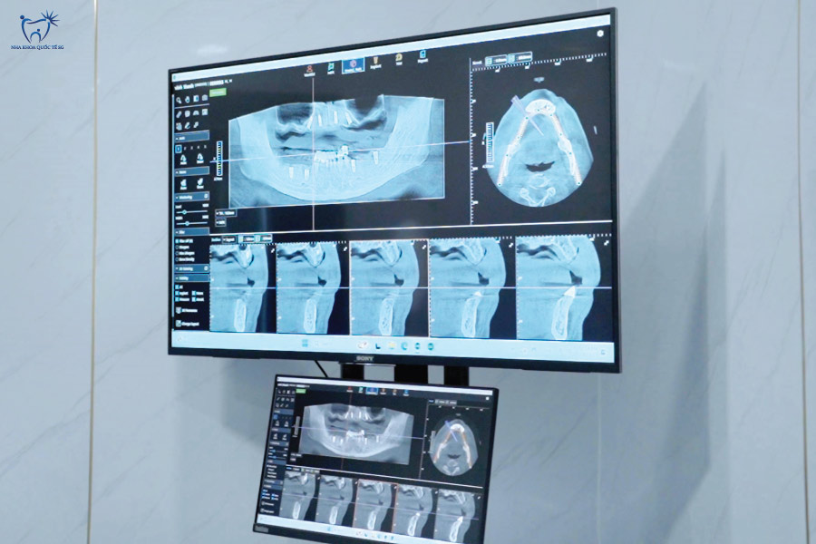 Chụp phim CT Cone Beam 3D tại Nha Khoa Quốc Tế SG