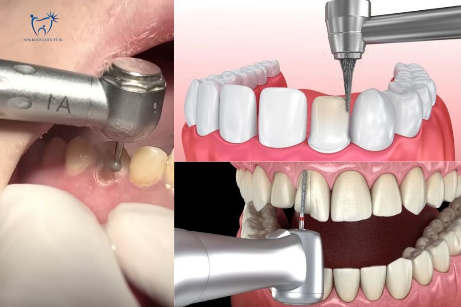 Mài răng trước khi bọc răng sứ