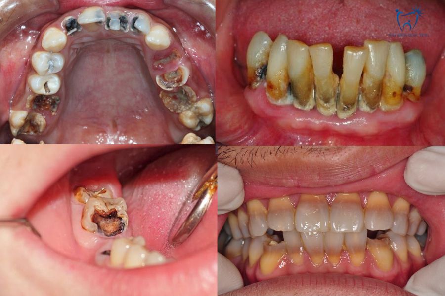 Hình ảnh thực tế bệnh nhân nên mài răng bọc sứ