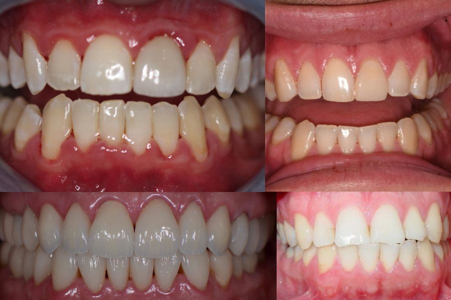 Hình ảnh thực tế răng khỏe mạnh không nên bọc sứ