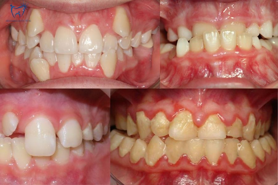 Hình ảnh thực tế răng lệch lạc không nên bọc sứ