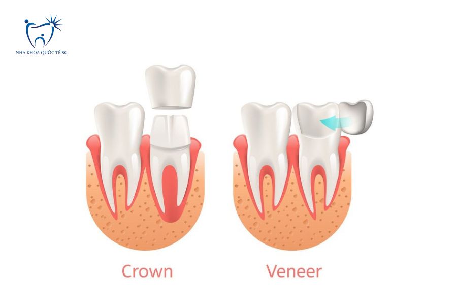 Bọc sứ và Veneer sẽ cần mài tỷ lệ khác nhau