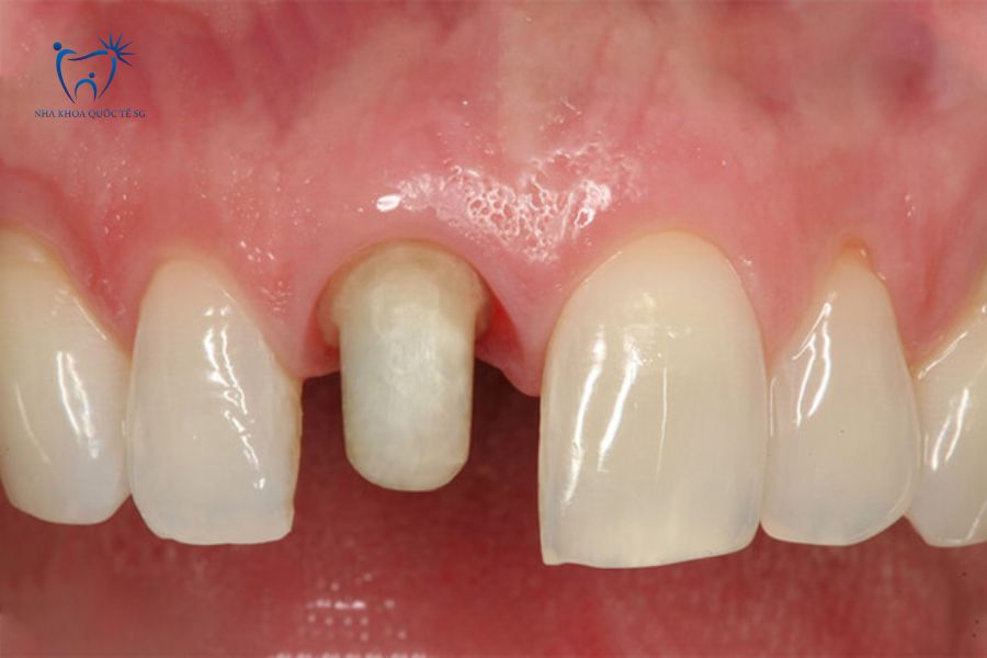 Hình ảnh thực tế bệnh nhân bị mài răng quá nhỏ