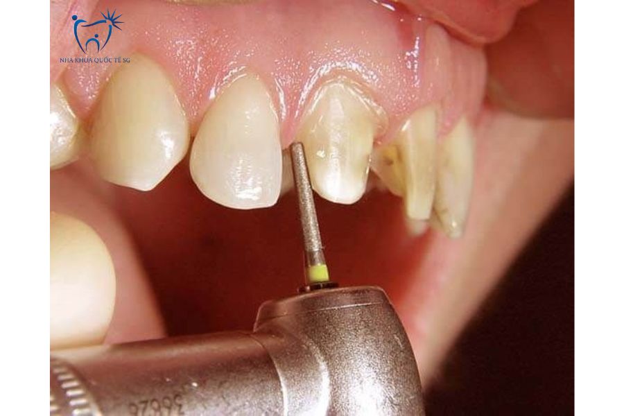 Mài răng trước khi bọc sứ
