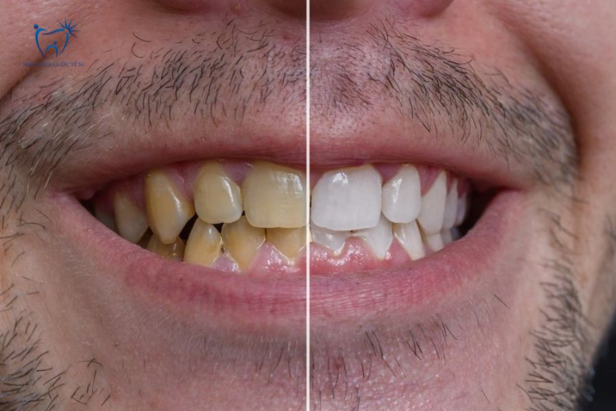 Trước và sau khi xử lý răng sứ bị vàng