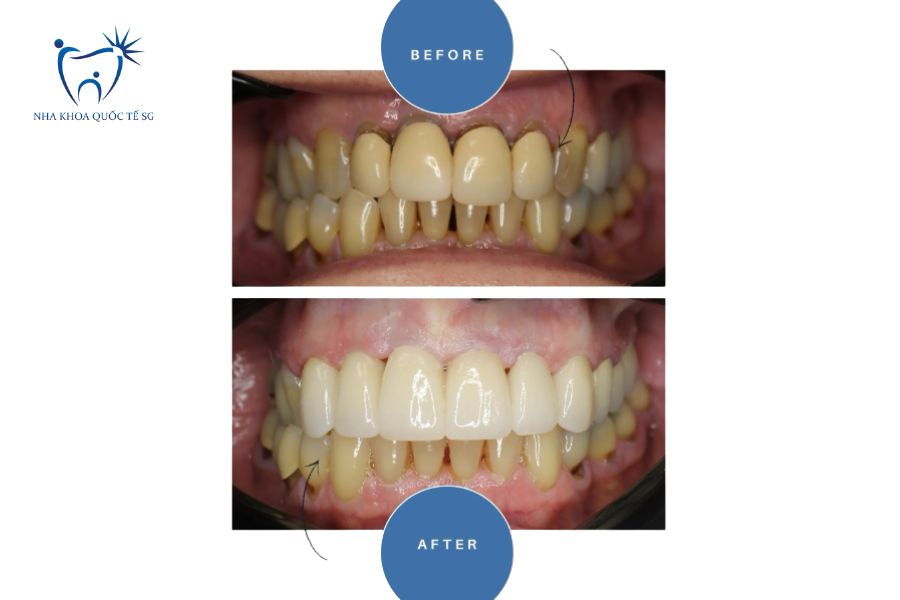 Hình ảnh bệnh nhân bọc sứ bị vàng răng