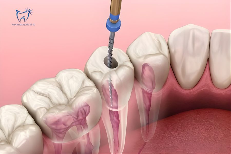 Nha Khoa Quốc Tế Sài Gòn Phương pháp chữa tủy xuyên qua mão