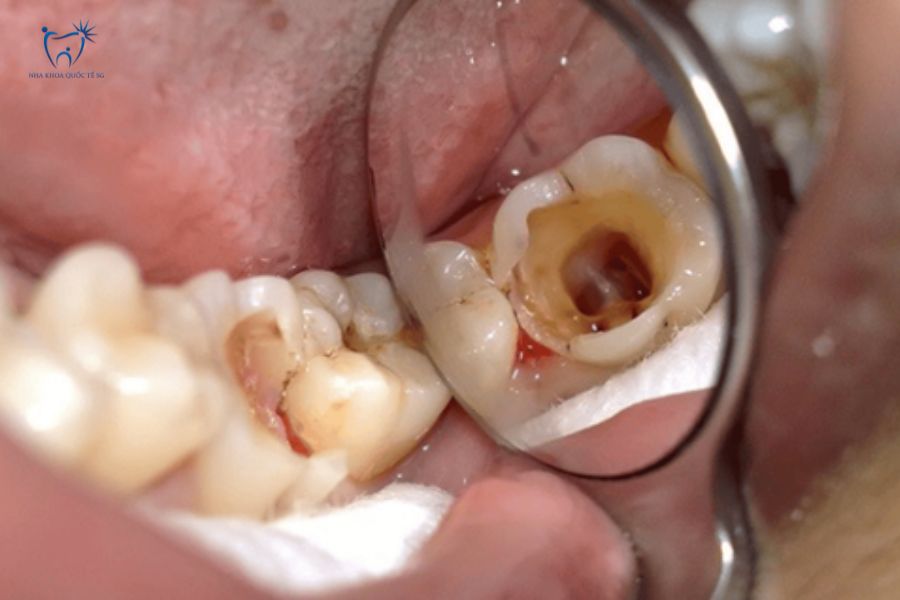Răng bị sâu nhưng khung răng còn tốt