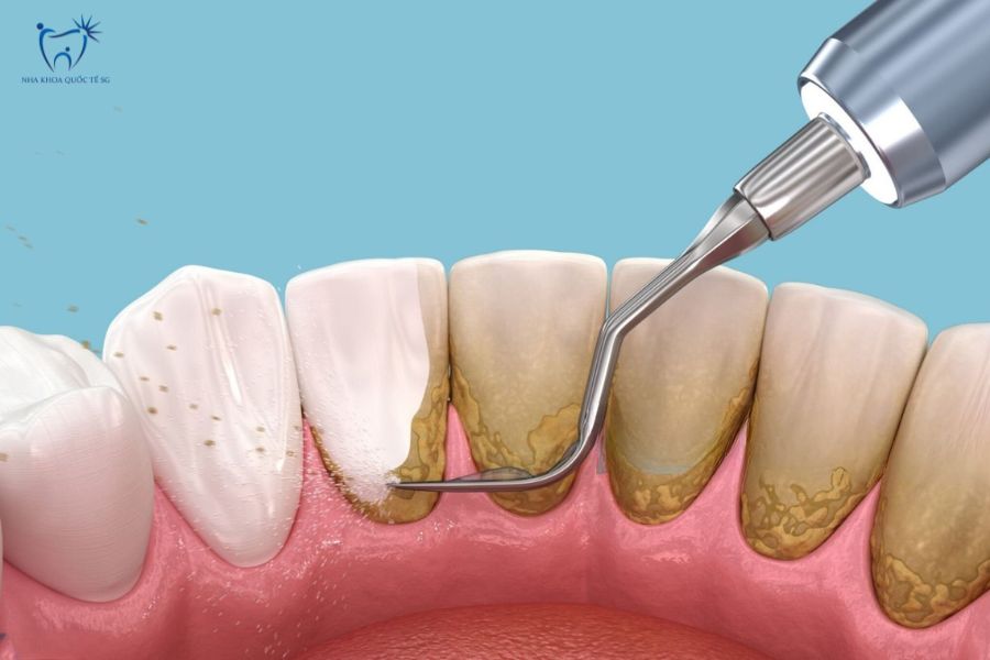 Nha Khoa Quốc Tế Sài Gòn Cạo vôi răng giúp loại bỏ mảng bám và vi khuẩn