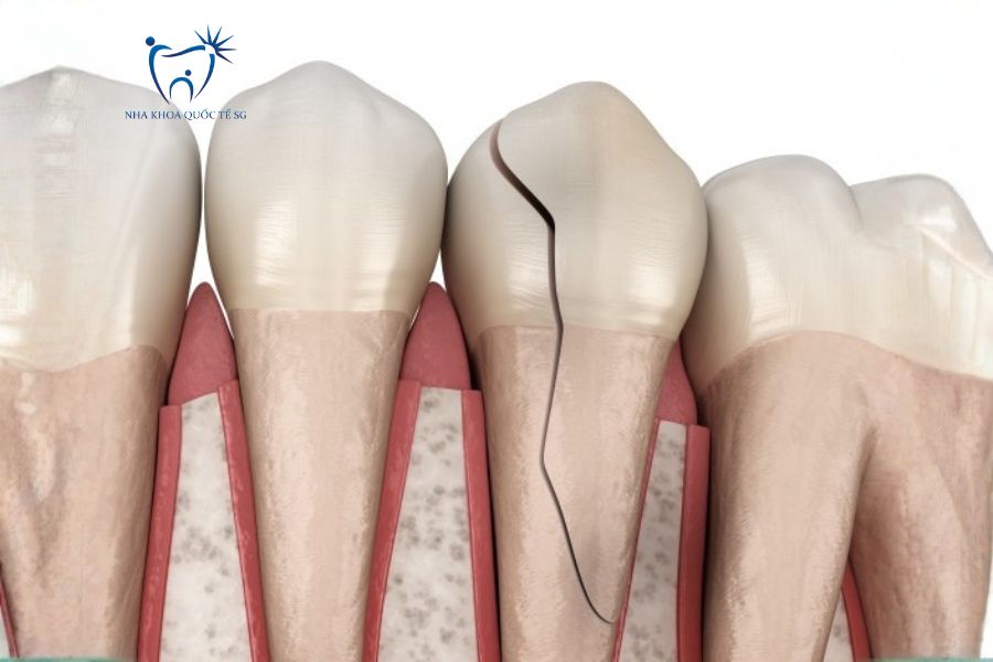 Nguy cơ nứt gãy răng nếu không bọc sứ sau khi lấy tủy
