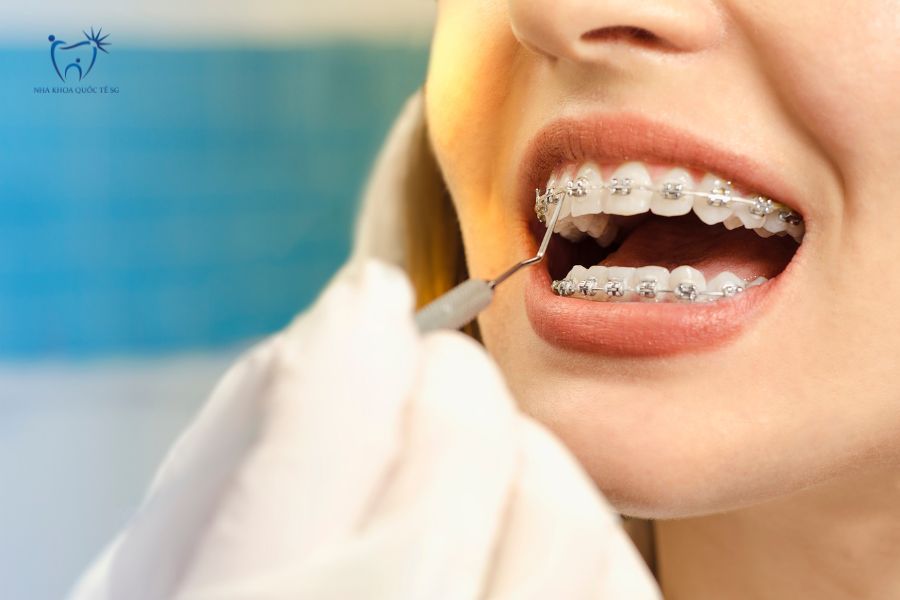 Nha Khoa Quốc Tế Sài Gòn Bệnh nhân niềng răng bởi bác sĩ tại nha khoa