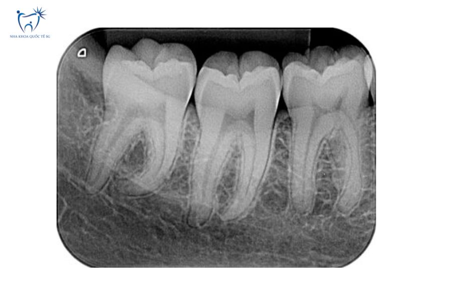 Nha Khoa Quốc Tế Sài Gòn Sử dụng X-quang cận chóp để kiểm tra viền mão