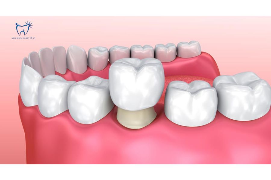 Nha Khoa Quốc Tế Sài Gòn Bọc sứ là phương pháp thẩm mỹ nha khoa