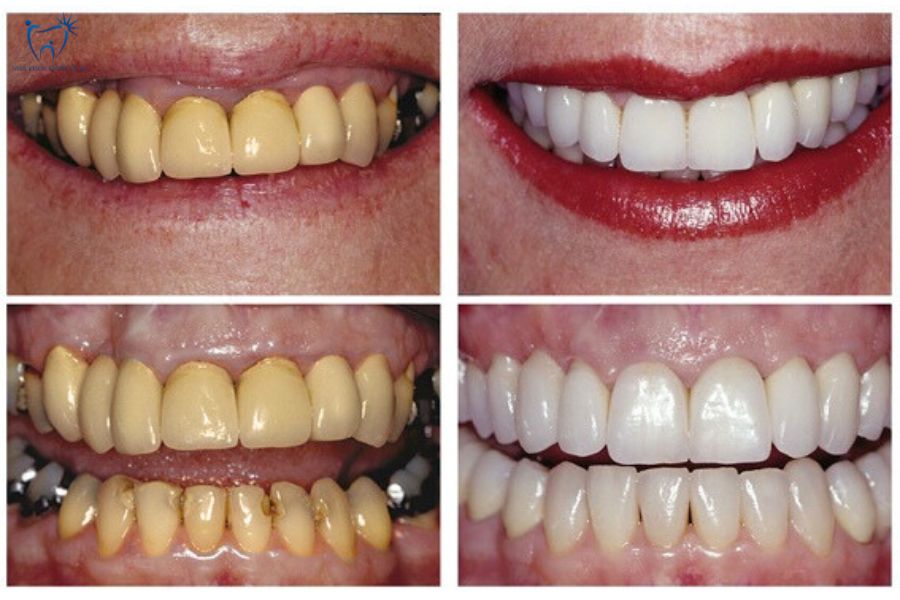 Trước và sau khi xử lý răng sứ kim loại bị vàng