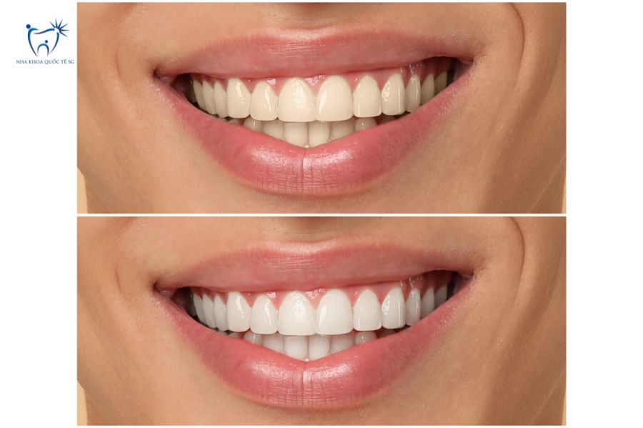 Hình ảnh trước và sau khi dán sứ Veneer