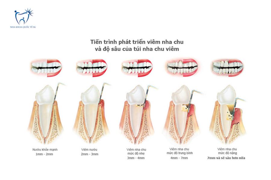 Tiến trình phát triển viêm nha chu và độ sâu