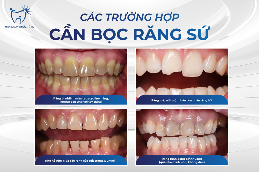 Nha Khoa Quốc Tế Sài Gòn Các trường hợp cụ thể nên bọc răng sứ