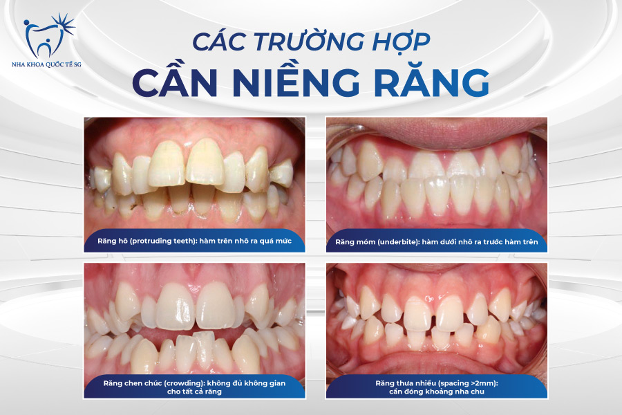 Nha Khoa Quốc Tế Sài Gòn Các trường hợp cụ thể nên niềng răng